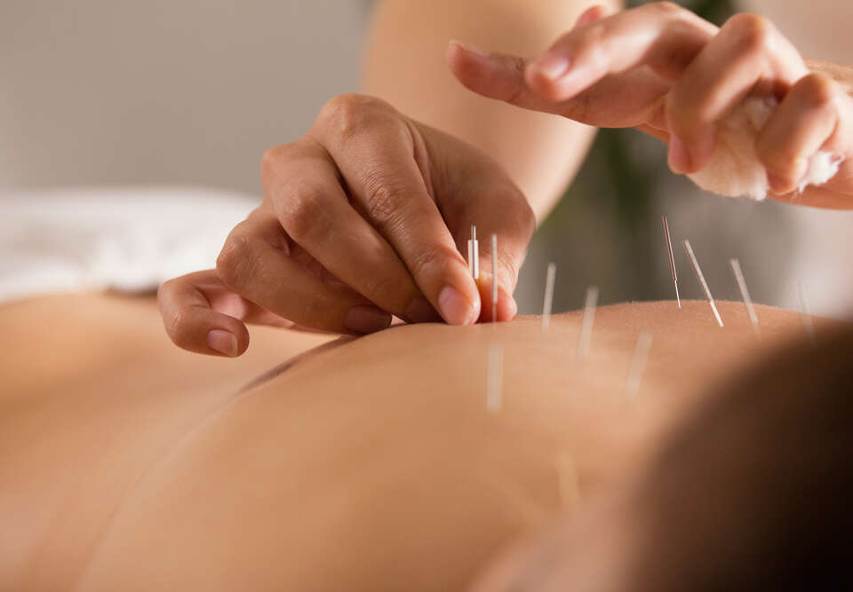 A close up of a patient undergoing acupuncture treatment